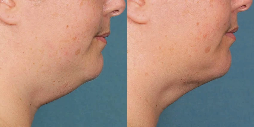 Real Patient Results of Motykie Med Spa serving West Hollywood & Beverly Hills, CA