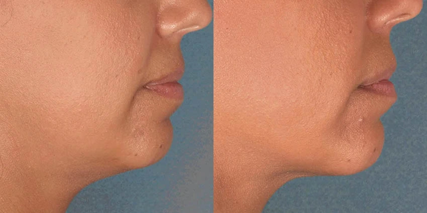 Real Patient Results of Motykie Med Spa serving West Hollywood & Beverly Hills, CA