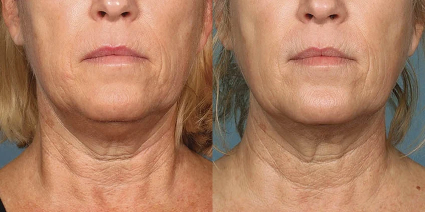 Real Patient Results of Motykie Med Spa serving West Hollywood & Beverly Hills, CA
