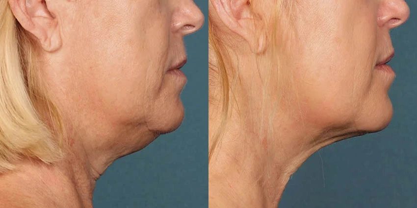 Real Patient Results of Motykie Med Spa serving West Hollywood & Beverly Hills, CA