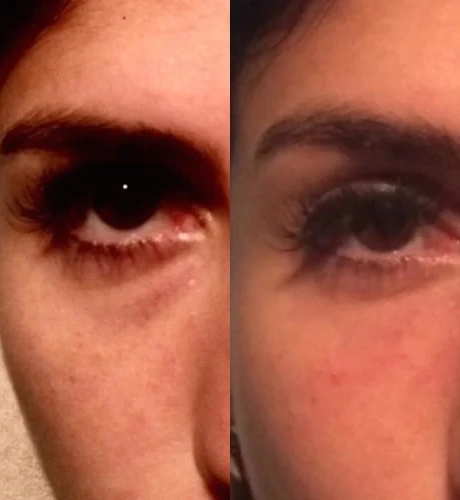 Real Patient Results of Motykie Med Spa serving West Hollywood & Beverly Hills, CA