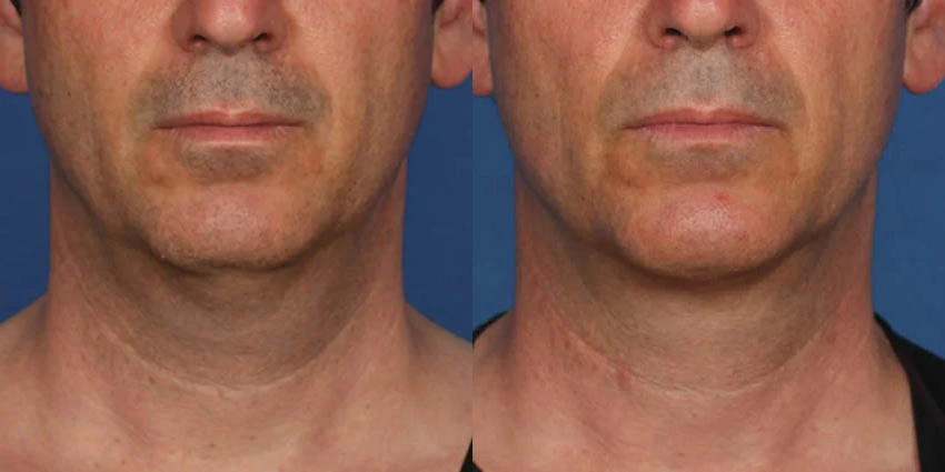 Real Patient Results of Motykie Med Spa serving West Hollywood & Beverly Hills, CA