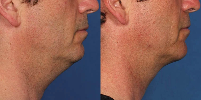 Real Patient Results of Motykie Med Spa serving West Hollywood & Beverly Hills, CA