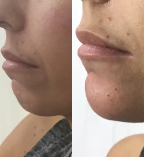 Real Patient Results of Motykie Med Spa serving West Hollywood & Beverly Hills, CA