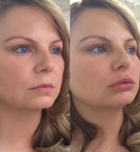 Real Patient Results of Motykie Med Spa serving West Hollywood & Beverly Hills, CA