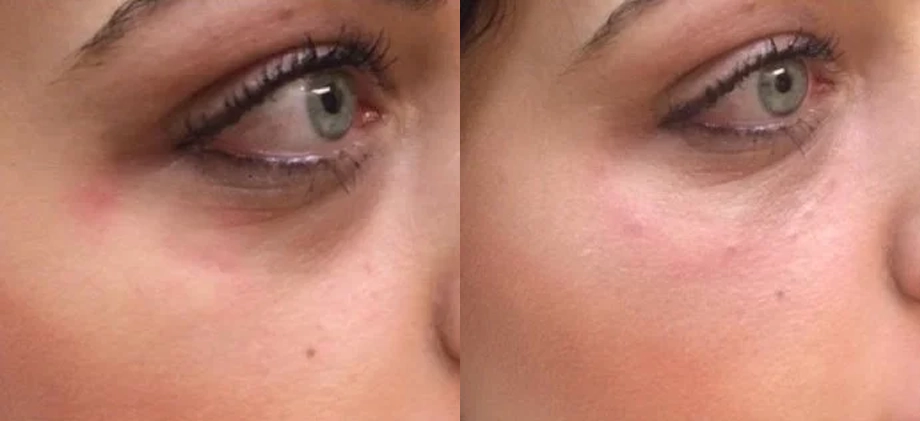 Real Patient Results of Motykie Med Spa serving West Hollywood & Beverly Hills, CA