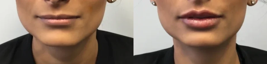 Real Patient Results of Motykie Med Spa serving West Hollywood & Beverly Hills, CA