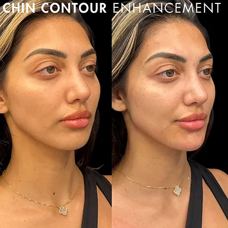 chin-contour